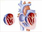 Пороки сердца - классификация, причины и симптоматика
