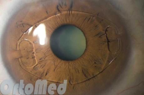 Результат имплантации ИОЛ глаза