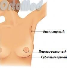 операция по увеличению груди