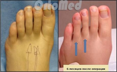 операция по уменьшению длины пальцев ног