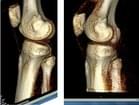 Биомеханика здорового коленного сустава и при развитии остеоартроза