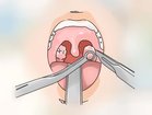 Паратонзиллярный абсцесс (горла)