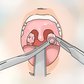 Паратонзиллярный абсцесс (горла)