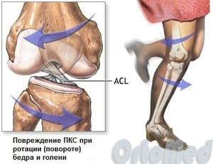 повреждение крестообразных связок колена
