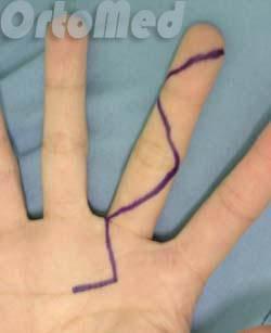 повреждения сухожилий сгибателей пальцев
