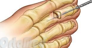 операция на молоткообразном пальце