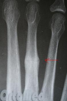 снимок перелома плюсневой кости стопы