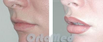 липофилинг губ фото до и после