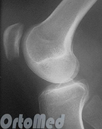 рентген колена