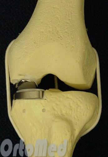 одномыщелковое эндопротезирование коленного сустава