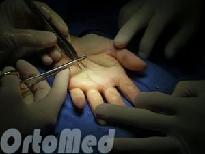щелкающий палец операция