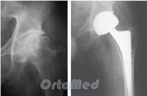 рентгенограмма до и после эндопротезирования тазобедренного сустава