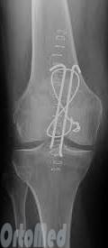 рентген после операции