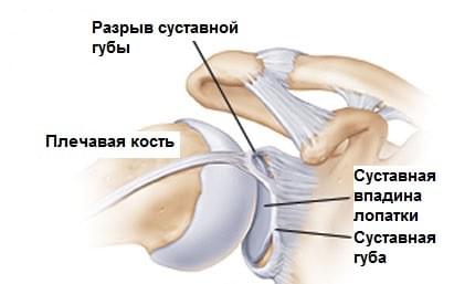разрыв связки плеча