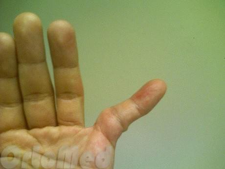 Вывих сустава пальца руки: симптомы, признаки, лечение | Вправить ...