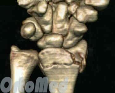 Осколочный перелом лучевой кости в типичном месте